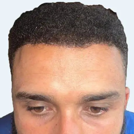 Hairline Restoration after treatment