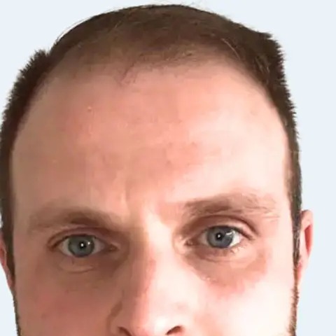 Crown Restoration before treatment