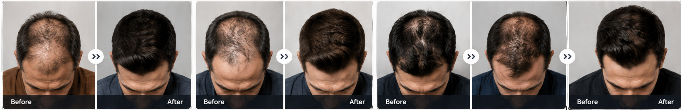 Real patient hair transplant result, before and after